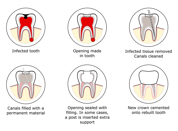 Root Canal Treatment Process